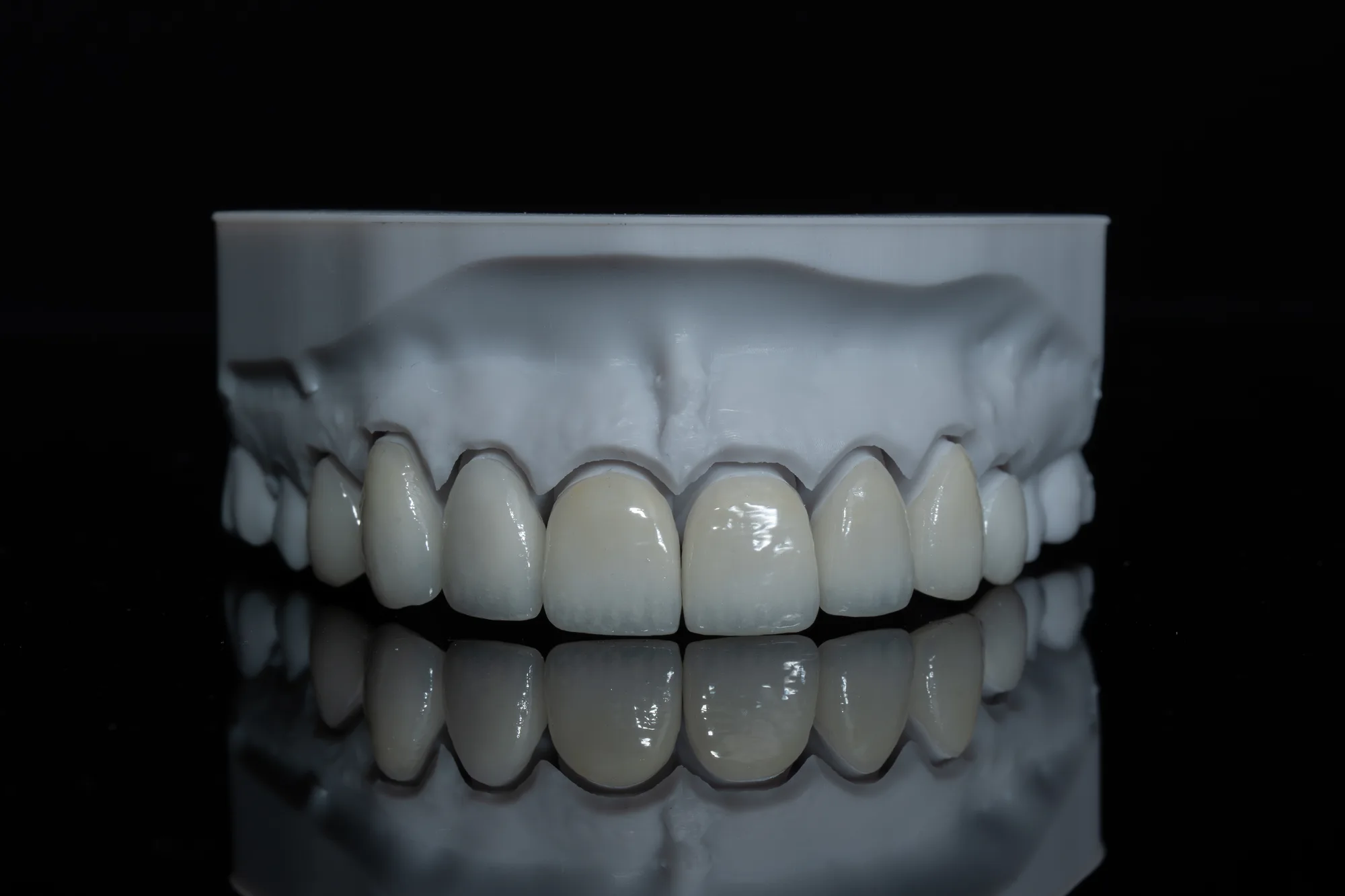 Veneers