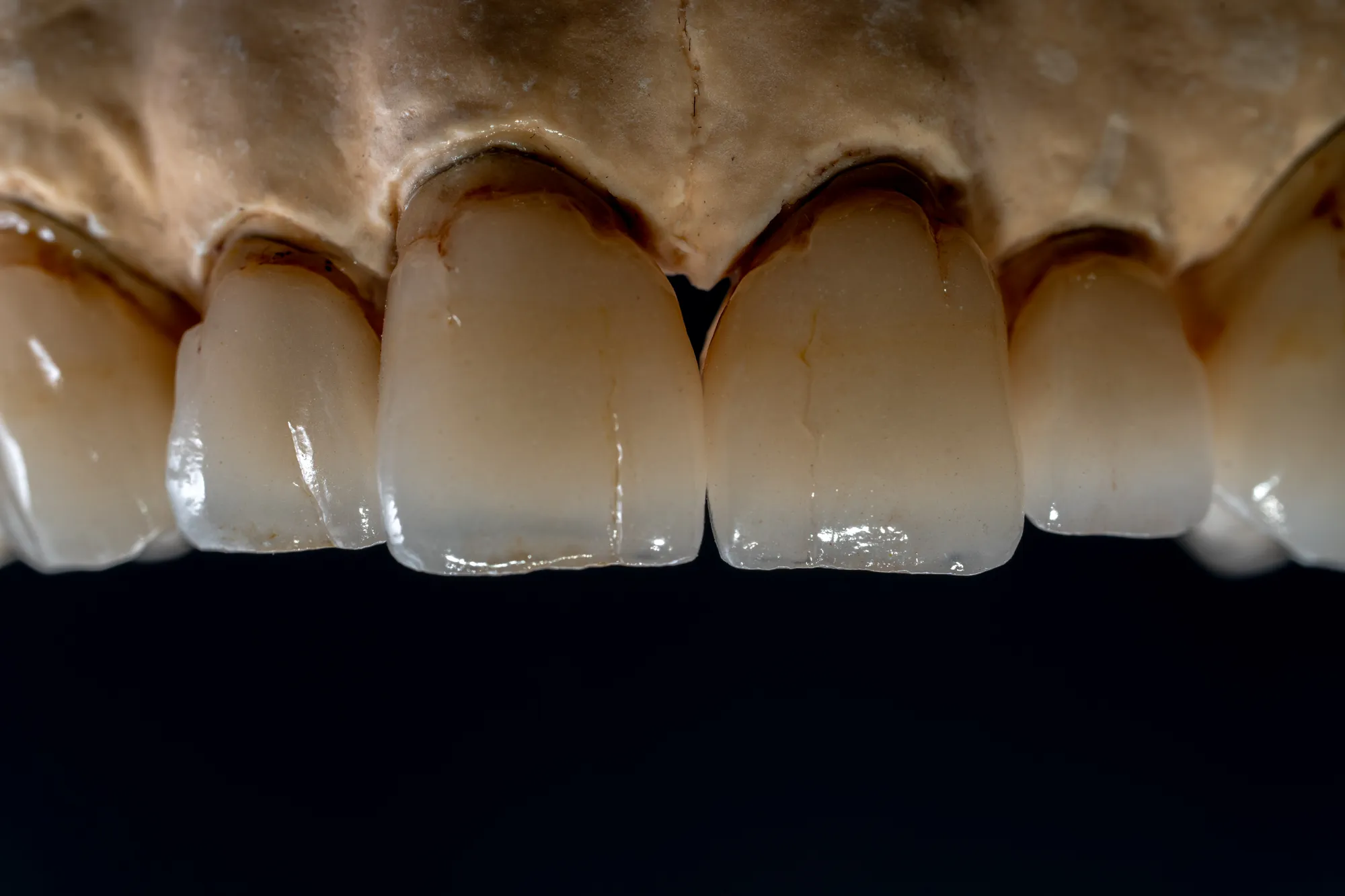 Clinical Cementation Workflow by Restoration Type