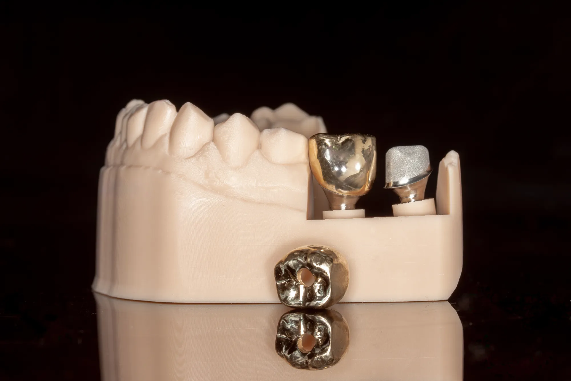 Single Implants