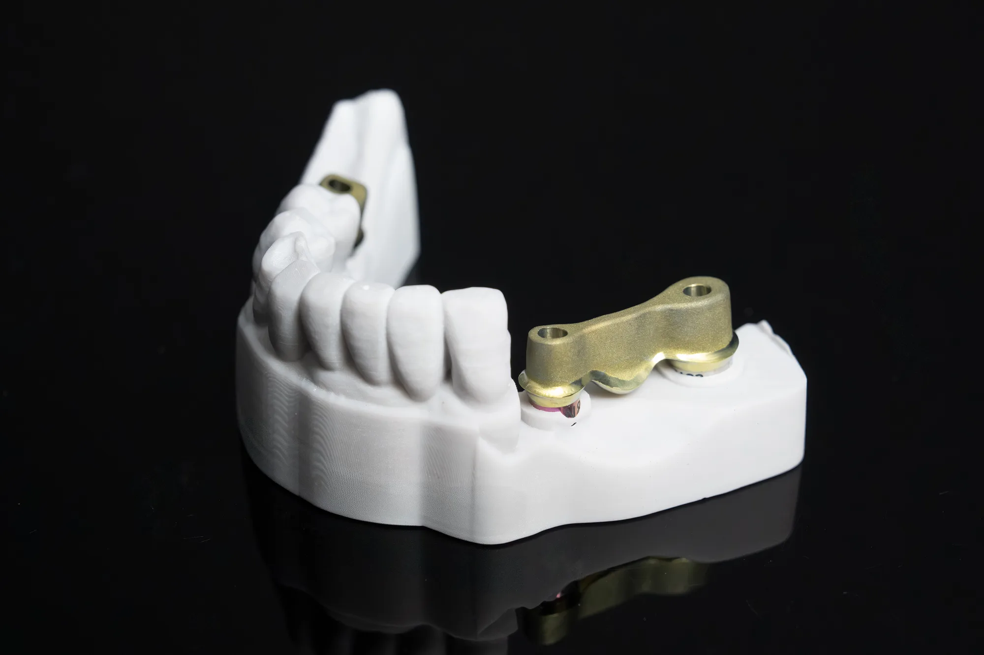 Implant Bridges — DA'AT Dental Lab