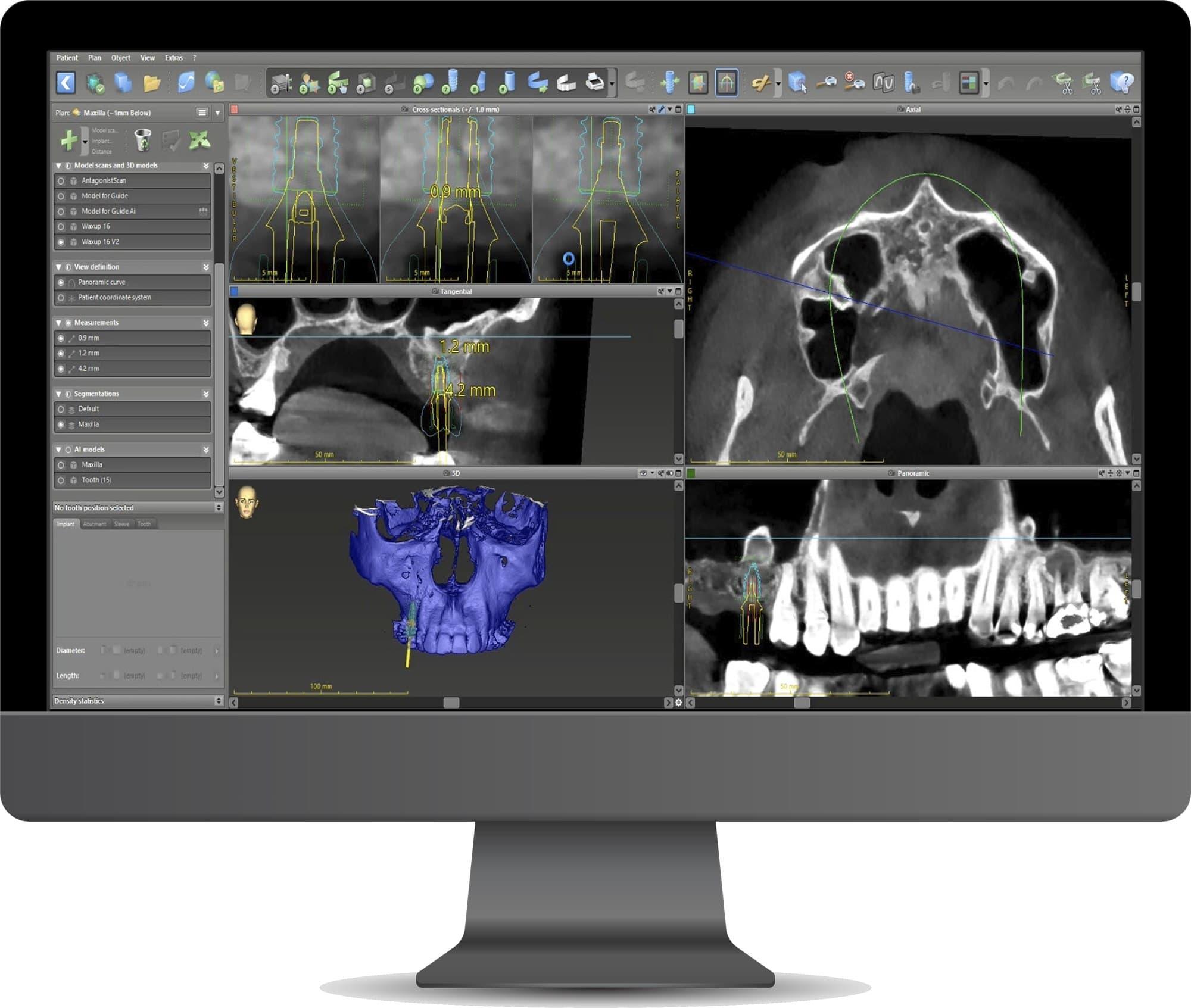 Surgical Guides case 6 — DA'AT Dental Lab