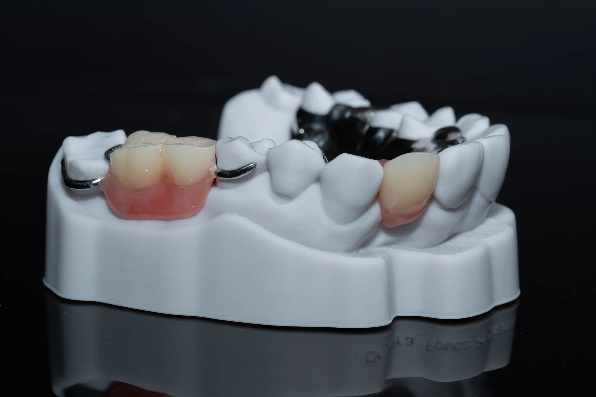 Partial Dentures case 4 — DA'AT Dental Lab