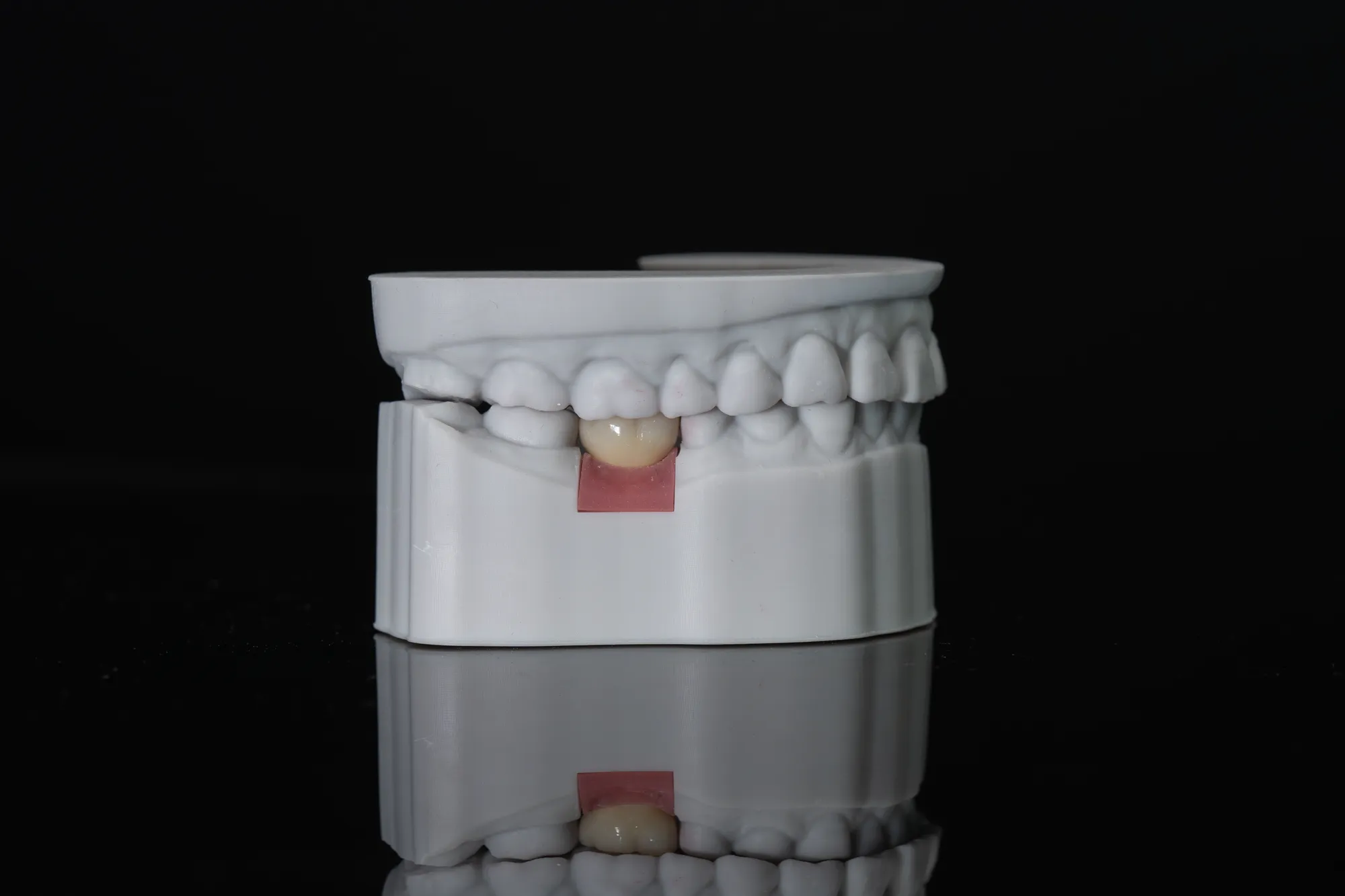 Single Implants
