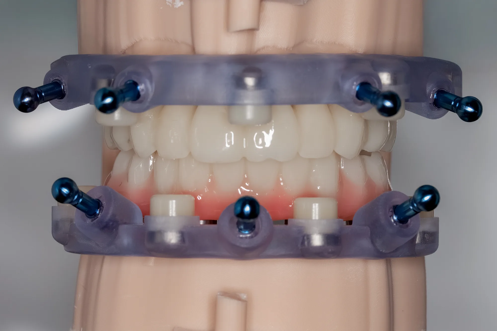 Surgical Guides case 5 — DA'AT Dental Lab