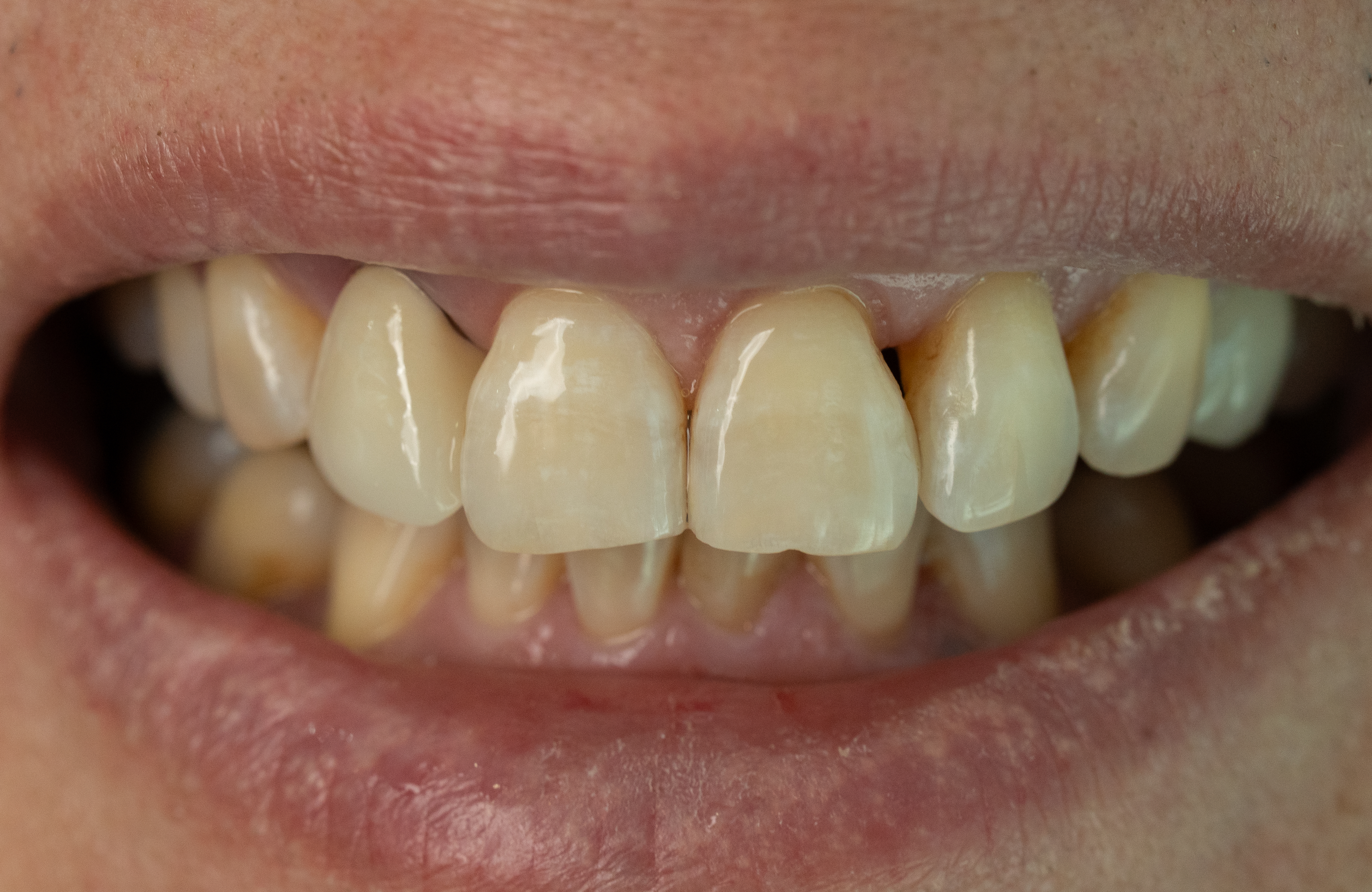 Anterior Aesthetic Case after