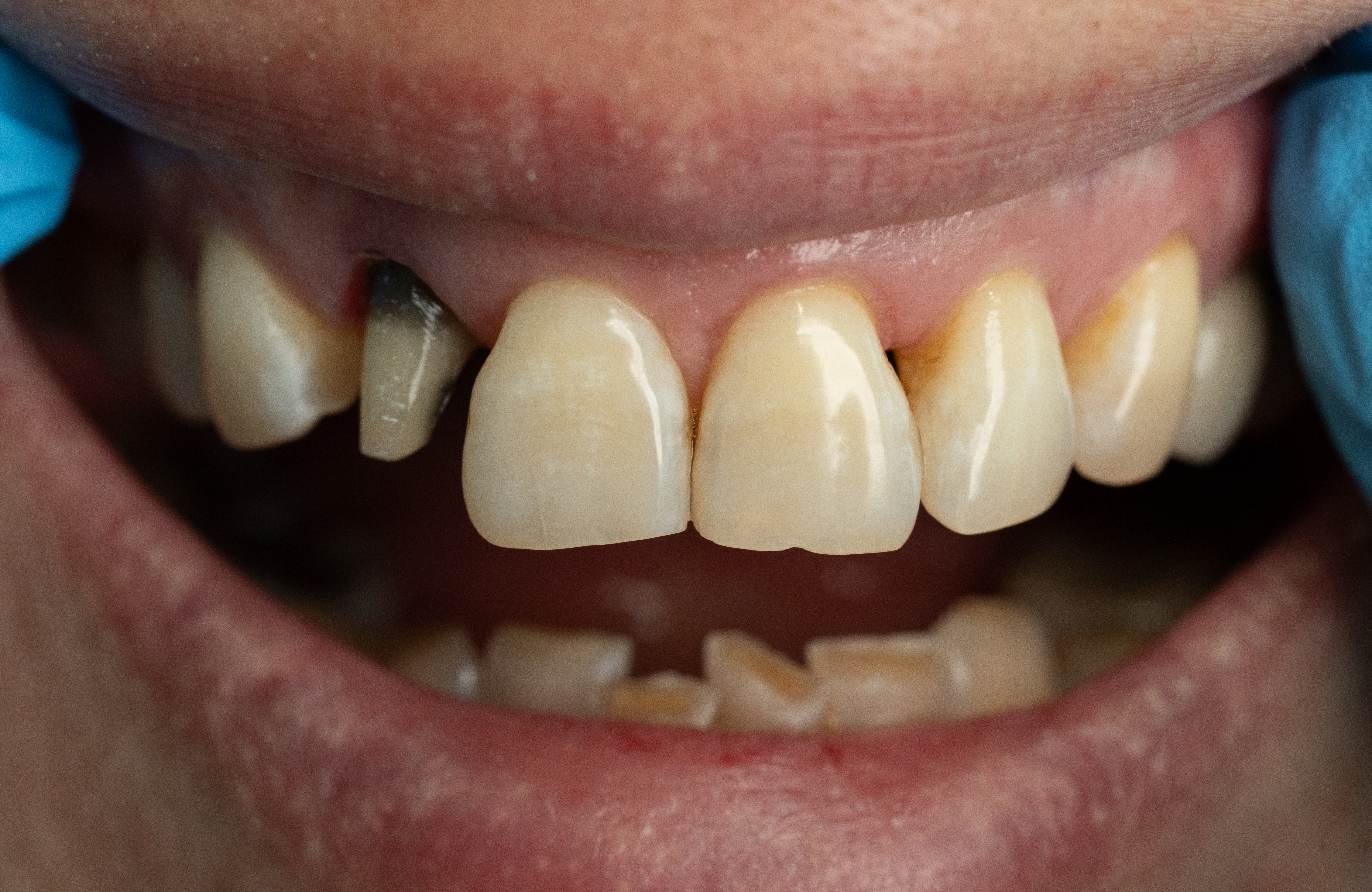 Anterior Aesthetic Case before