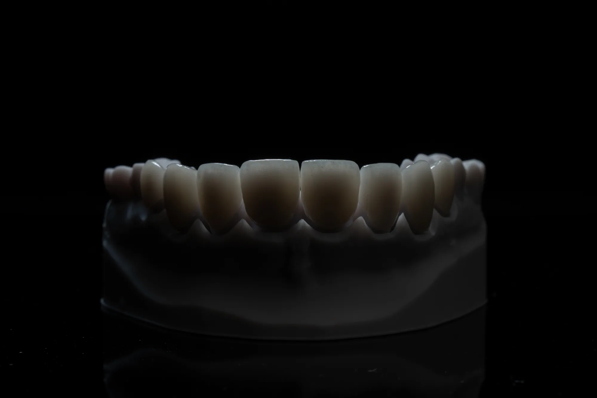 Porcelain Veneers case 2 — DA'AT Dental Lab
