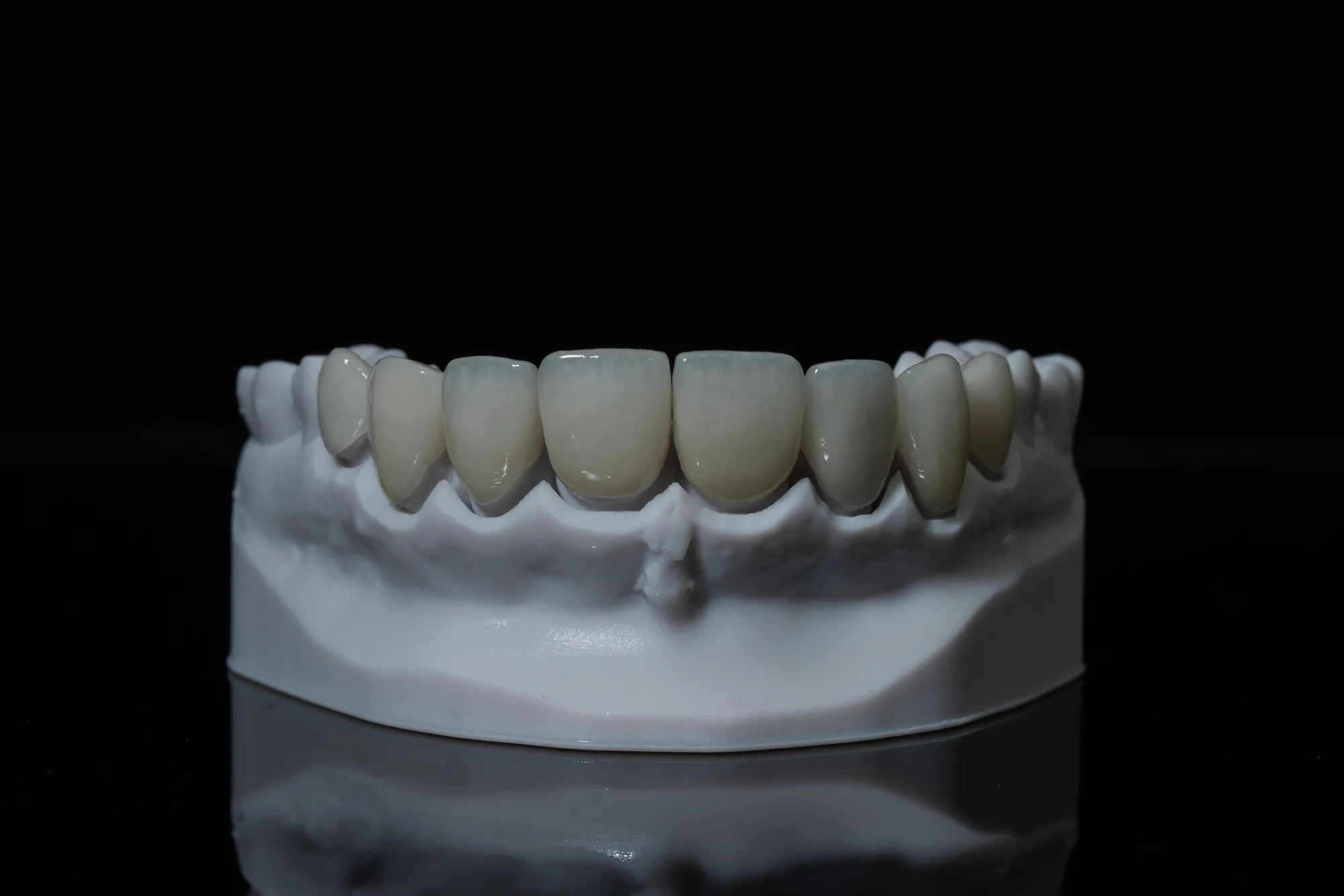 Porcelain Veneers case 3 — DA'AT Dental Lab