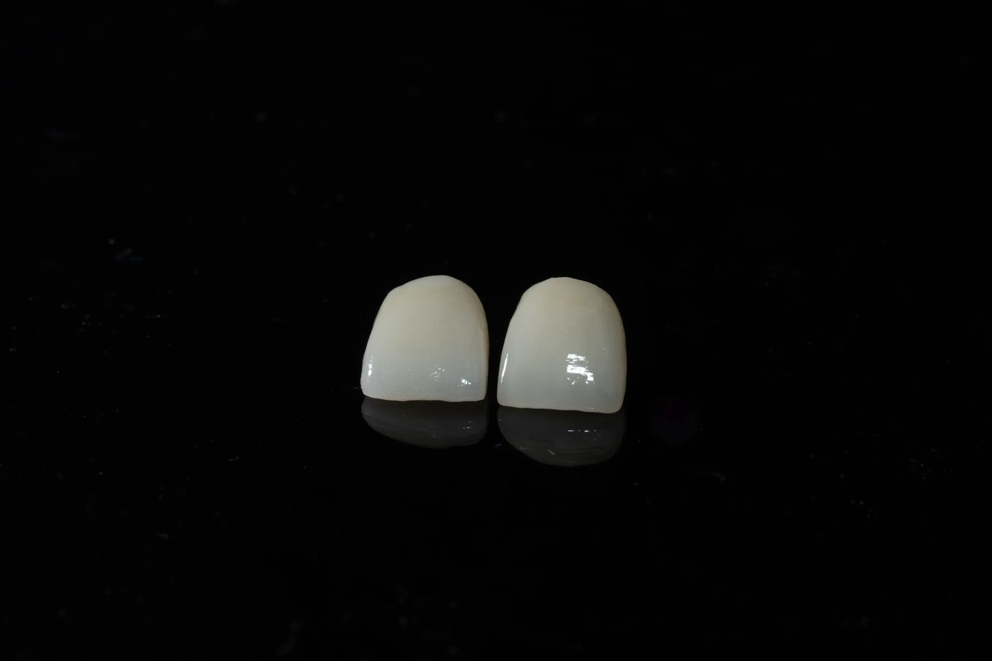 Porcelain Veneers case 4 — DA'AT Dental Lab