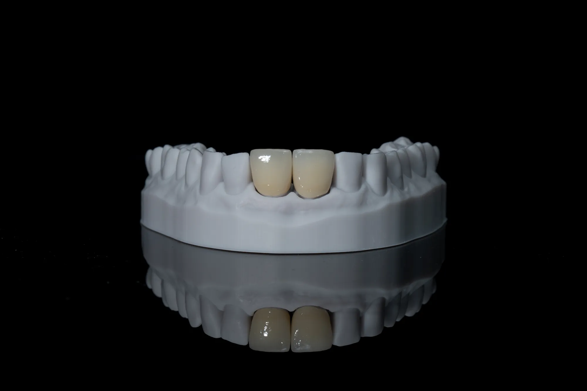 Porcelain Veneers — DA'AT Dental Lab
