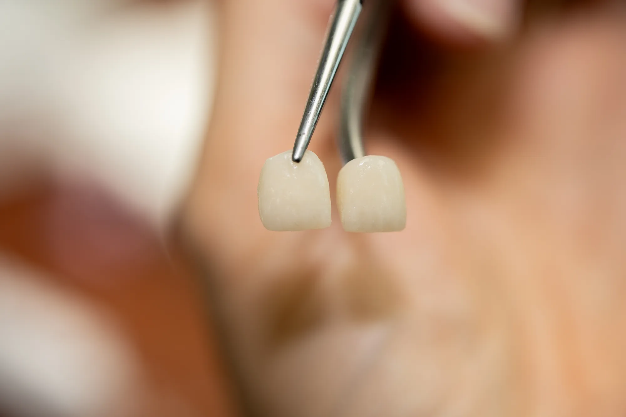 Porcelain Veneers case 5 — DA'AT Dental Lab