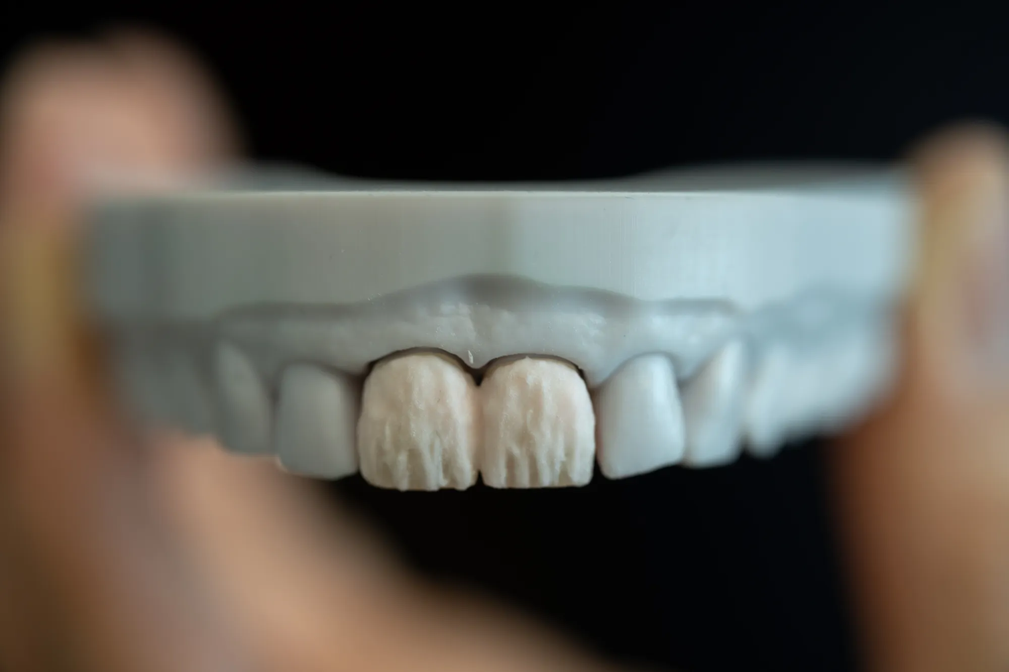 Porcelain Veneers case 6 — DA'AT Dental Lab