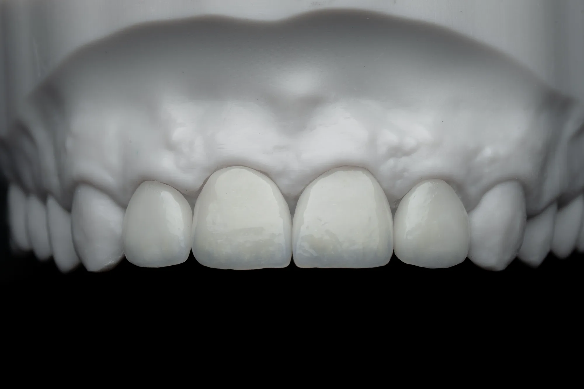 Veneers